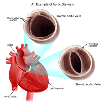 Cardiac Stenosis