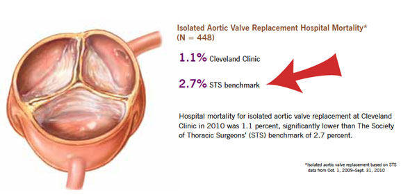 Aortic Valve Replacement Surgery Risks Mortality Rates