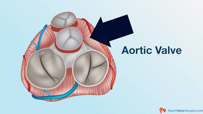 Dilated Aortic Root Progression: What Should Patients Know?