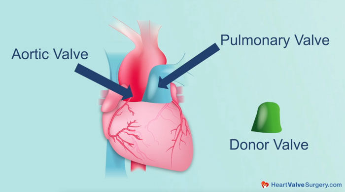 Aortic Valve Reconstruction Surgery: Patient Advantages