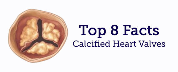 Heart Valve Calcification 8 Important Facts