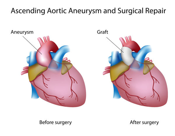 Top 5 Facts About Your Aorta & Bicuspid Aortic Valves