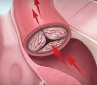 Facts About Aortic Stenosis with Doctor Marc Gillinov, MD