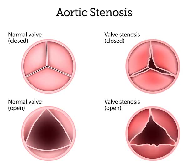 Aortic Stenosis Symptoms Causes Surgery