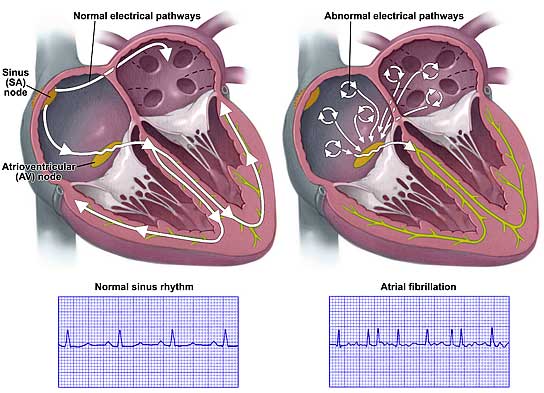 interview-about-atrial-fibrillation-valve-disease