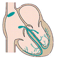 Atrioventricular Block After Heart Valve Surgery