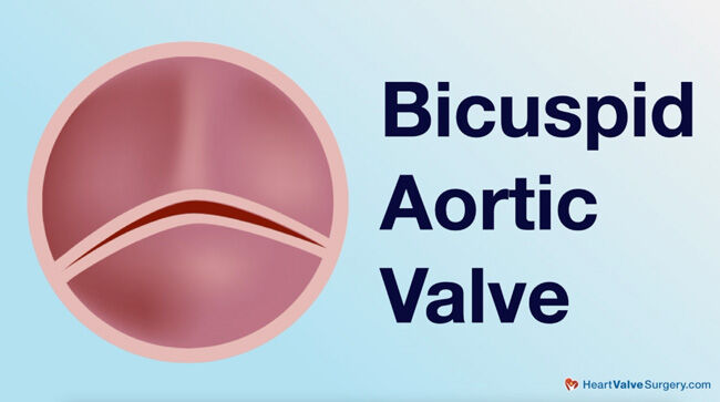 Bicuspid Aortic Valve