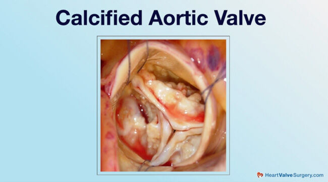 Stroke Risk Heart Valve Calcification Doctor Q A