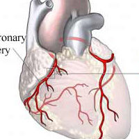 Coronary Artery Disease & Blockages After Heart Surgery