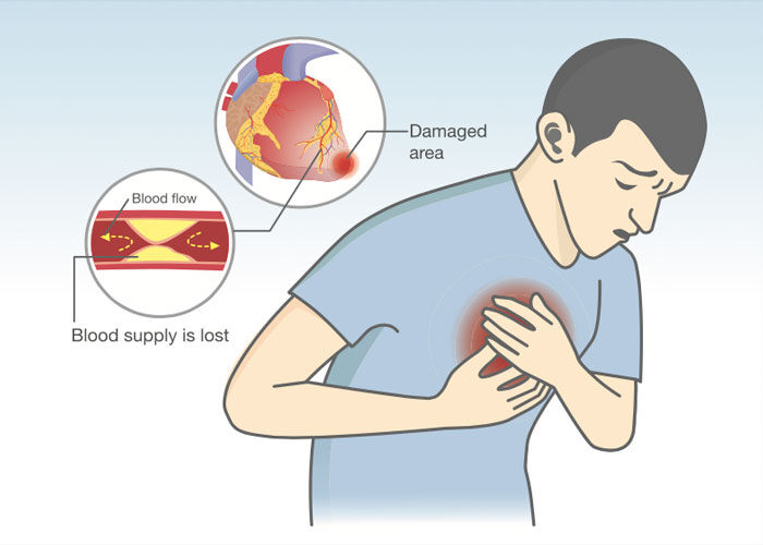 Coronary Artery Disease & Heart Valve Surgery: Top 9 Facts