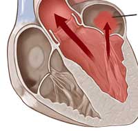 Heart Valve Leakage After Valve Repair Surgery - Is It Common?