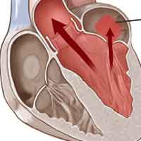 Heart Valve Leakage After Valve Repair Surgery - Is It Common?