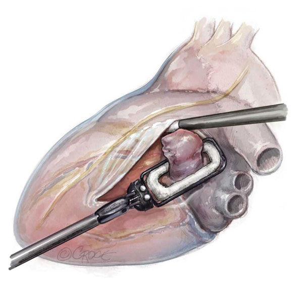 Cardiac Amyloidosis: What Should Heart Valve Patients Know?