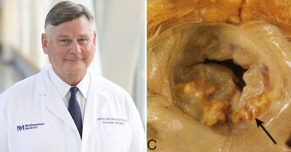 Mitral Annular Calcification with Dr. Patrick McCarthy