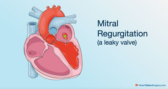 Robotic Mitral Valve Repair Surgery: What Should You Know?