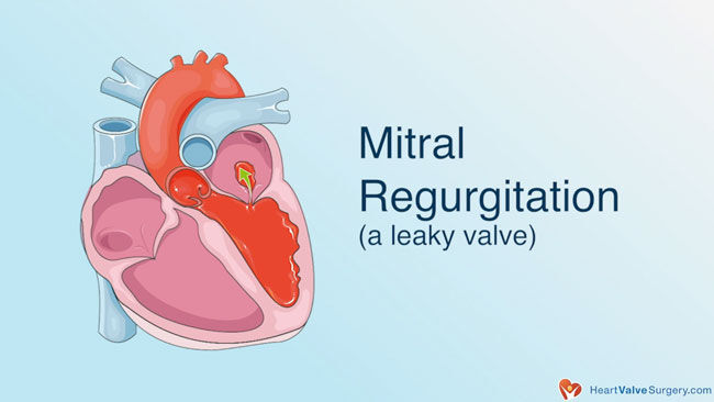 Top 6 Mitral Valve Surgery Myths Busted!