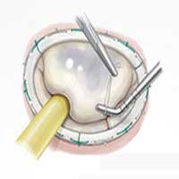 3 Patient Tips To Get Great Mitral Valve Surgery Outcomes