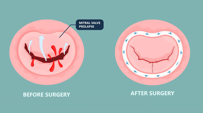 robotic-mitral-valve-repair-surgery-what-should-you-know