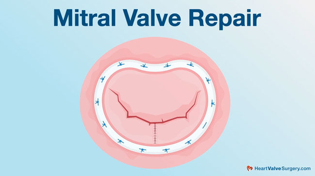 Mitral Valve Repair Success Story: Janet Peterson