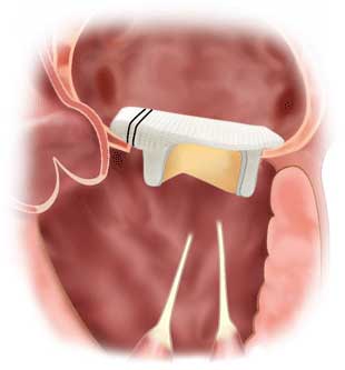 Mitral Valve Replacement Reoperation - Failed Leaflets