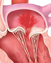 Primary vs. Secondary Mitral Regurgitation: 5 Facts to Know