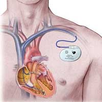 Pacemaker Implant After Heart Valve Surgery & MAZE Procedure