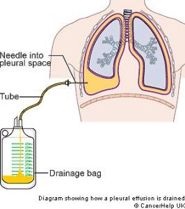 Pleural Effusions After Heart Valve Surgery -- Patient Details