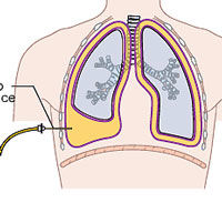 Pleural Effusions After Heart Valve Surgery -- Patient Details