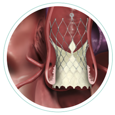 TAVR Medtronic