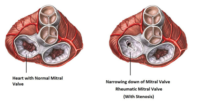 Rheumatic Fever Heart Valve Disease 8 Important Facts