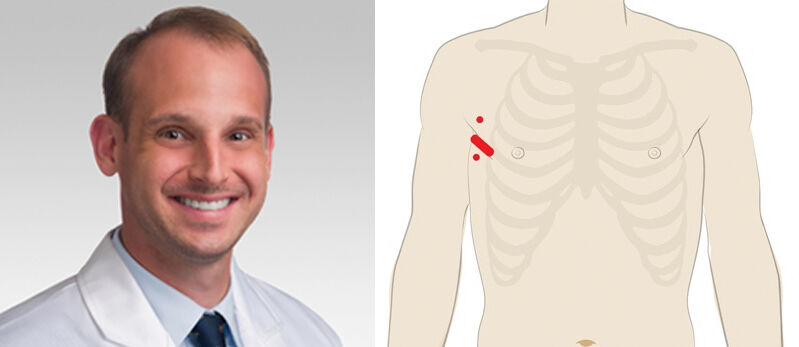 Dr. Kevin Hodges Robotic Mitral Valve Surgery