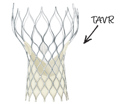 TAVR Procedure Information - For Patients & Caregivers