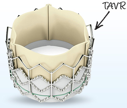 TAVR Procedure Information - For Patients & Caregivers