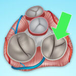 tricuspid-patient-webinar