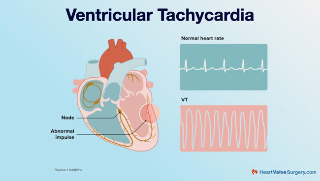 Surgeon Q&A: Can Mitral Regurgitation Cause A Stroke?