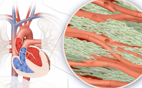 Cardiac Amyloidosis