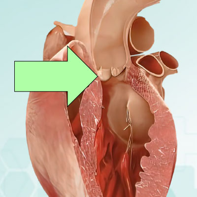 Aortic Root Carving