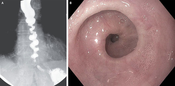 Corkscrew Esophagus