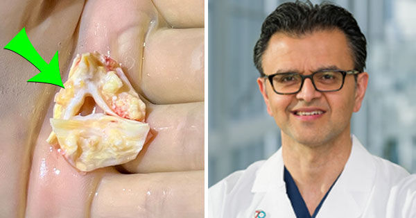 Calcified Aortic Heart Valves with Dr. Neelan Doolabh