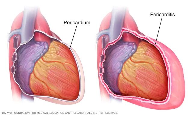 Pericarditis from Dressler's Syndrome