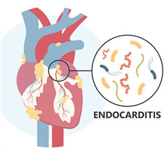 Bacterial Endocarditis Heart Valve Disease