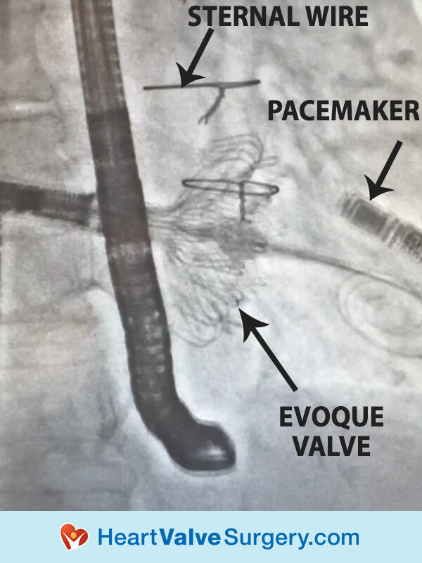 Evoque transcatheter tricuspid valve replacement