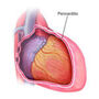 Pericarditis - Dresslers Syndrom