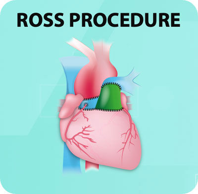 Ross Procedure Surgery