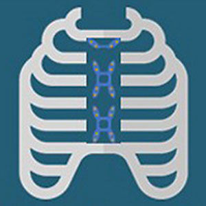 Sternotomy Recovery Research