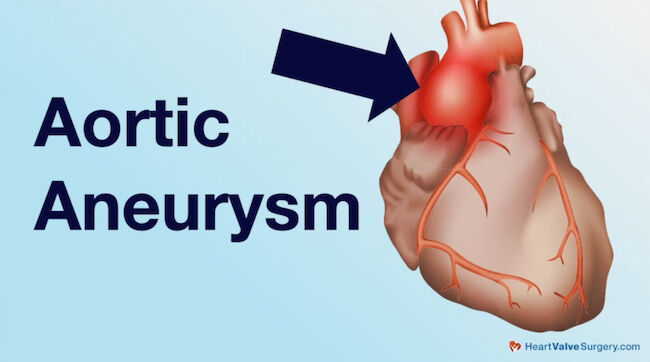 Drawing of an Aortic Aneurysm