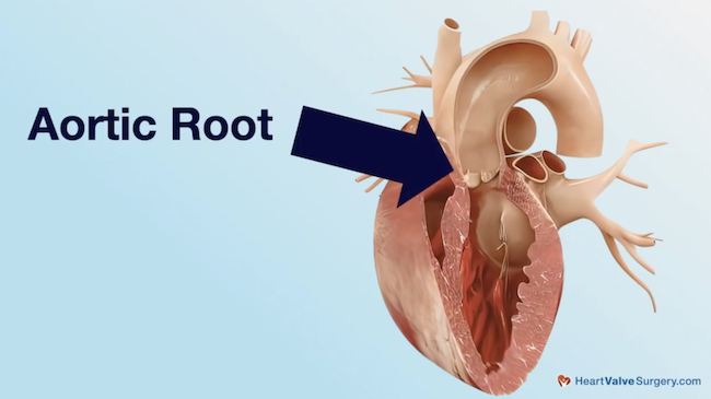 Aortic Root Heart Model