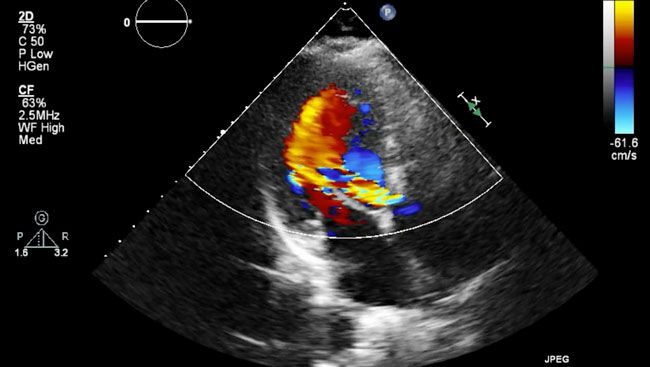 Heart Failure Echocardiogram