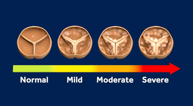 Aortic Stenosis Progression