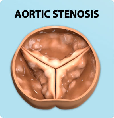 Aortic Valve Stenosis